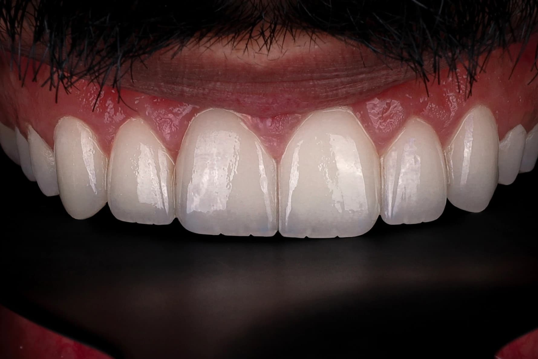 Dentist discussing E-max veneer costs and smile treatment planning with a patient in Dubai