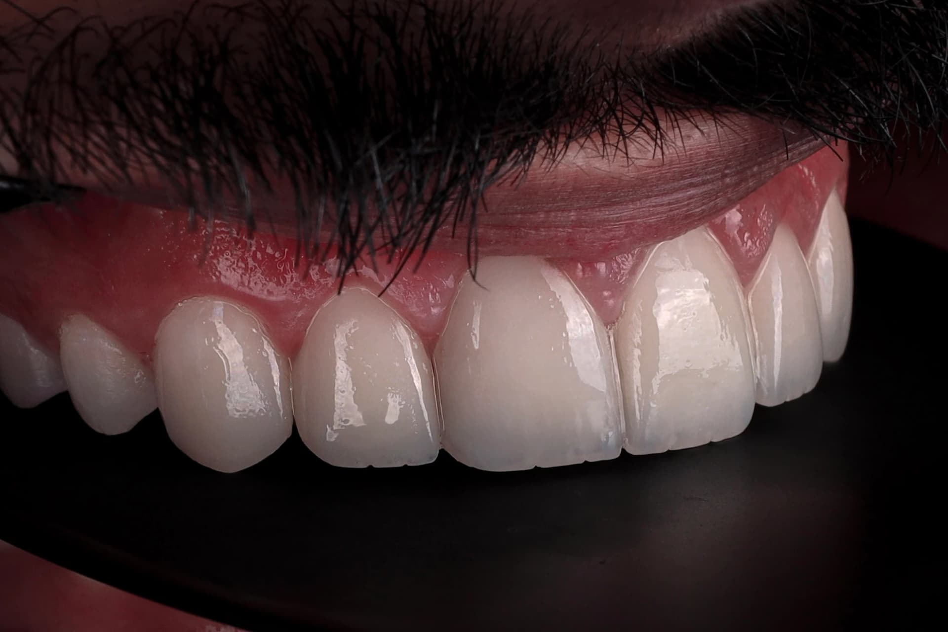Dentist examining E-max and porcelain veneers during a long-term follow-up appointment in Dubai