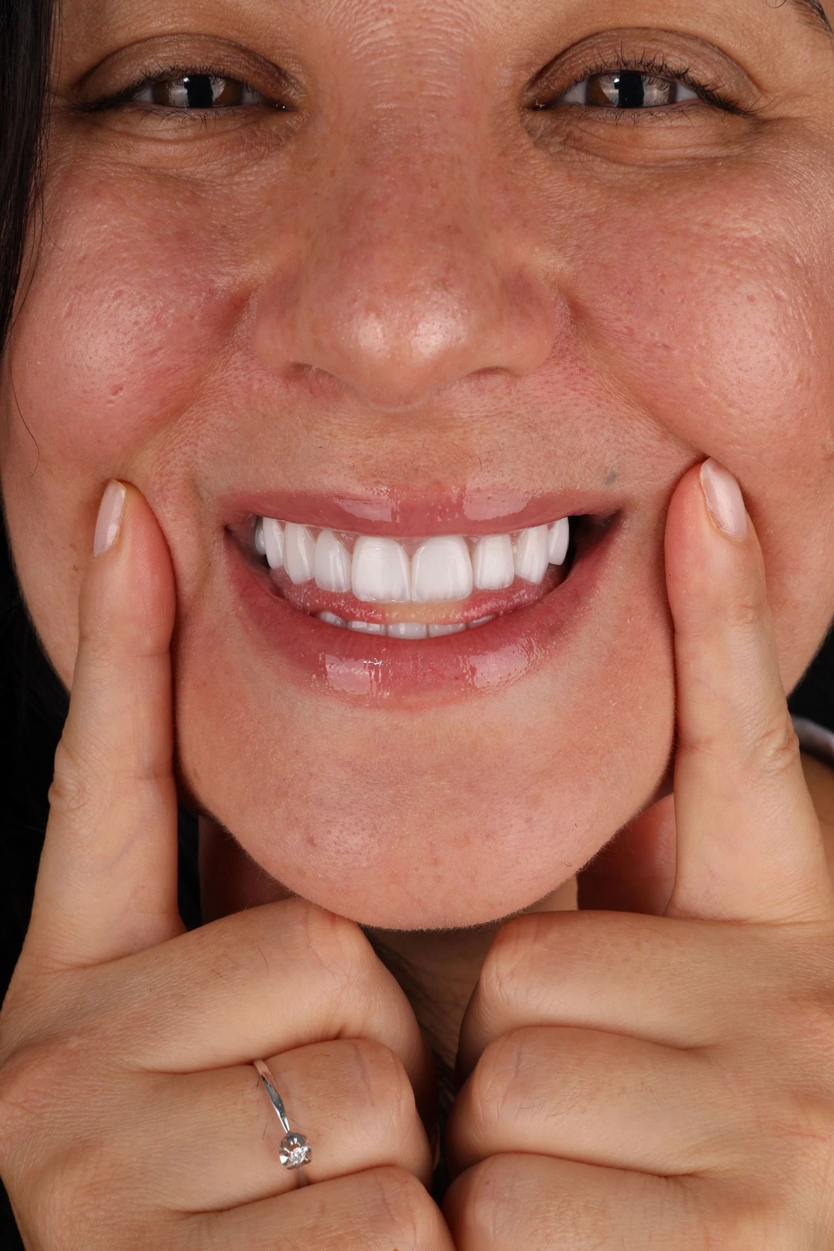 Patient smile result 22