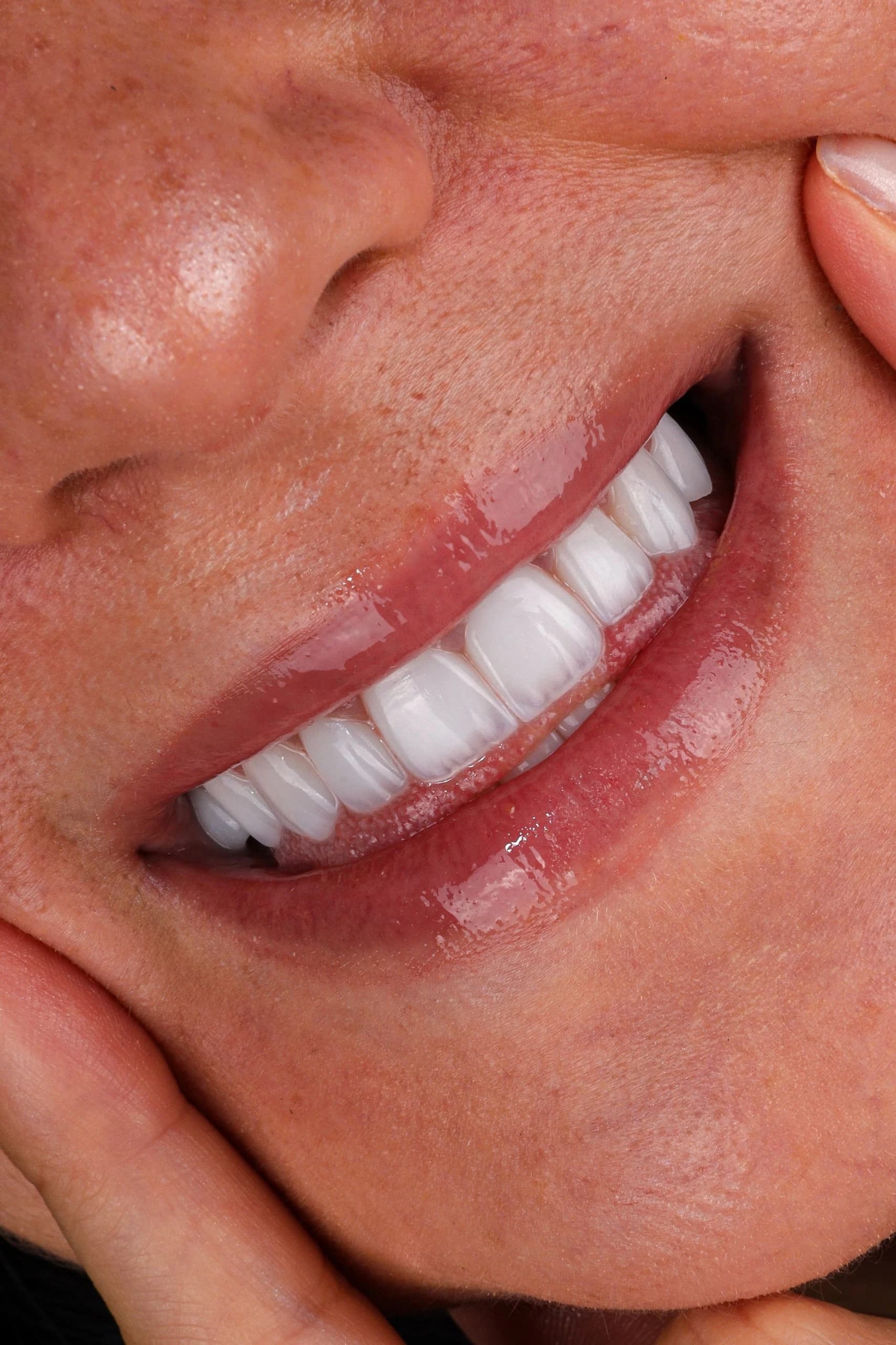 Digital smile planning to determine how many veneers a patient needs in Dubai