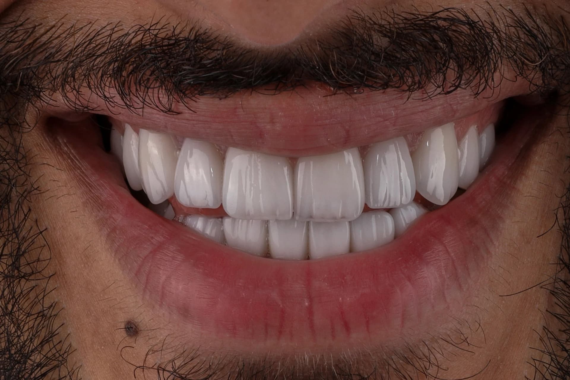 Porcelain Veneers