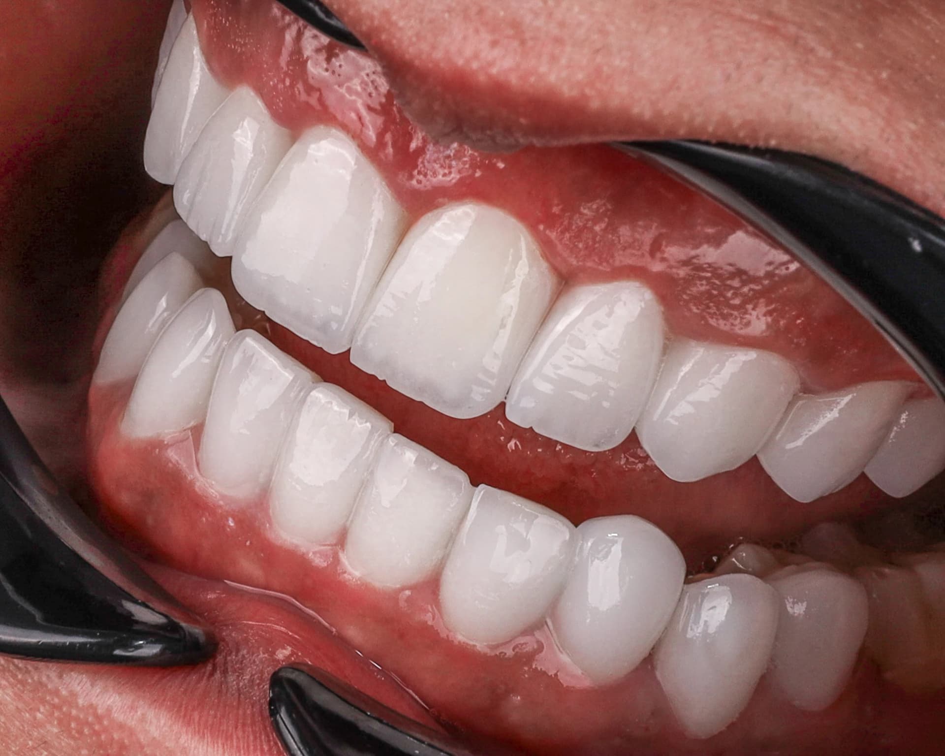 طبيب أسنان يشرح الفرق بين ابتسامة هوليوود وفينير الأسنان في دبي
