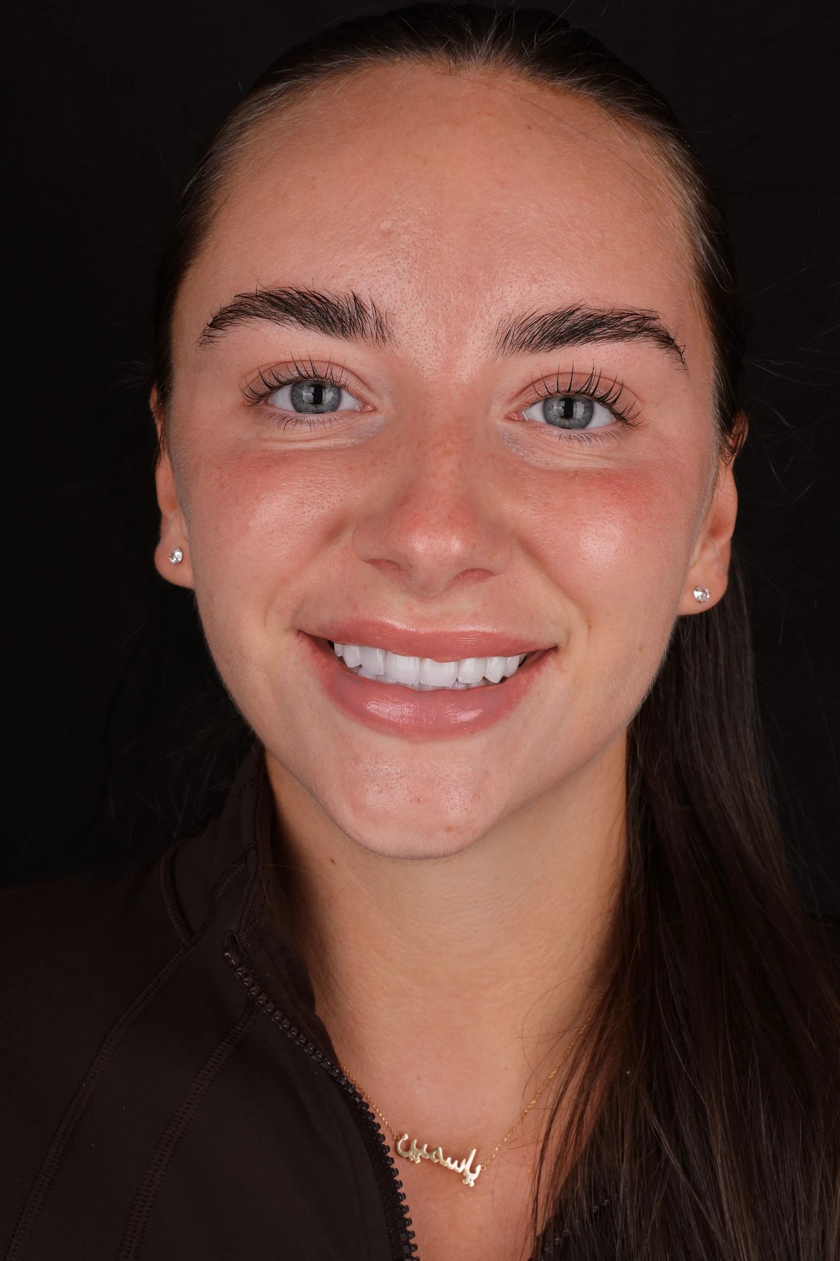 Patient smile result 18
