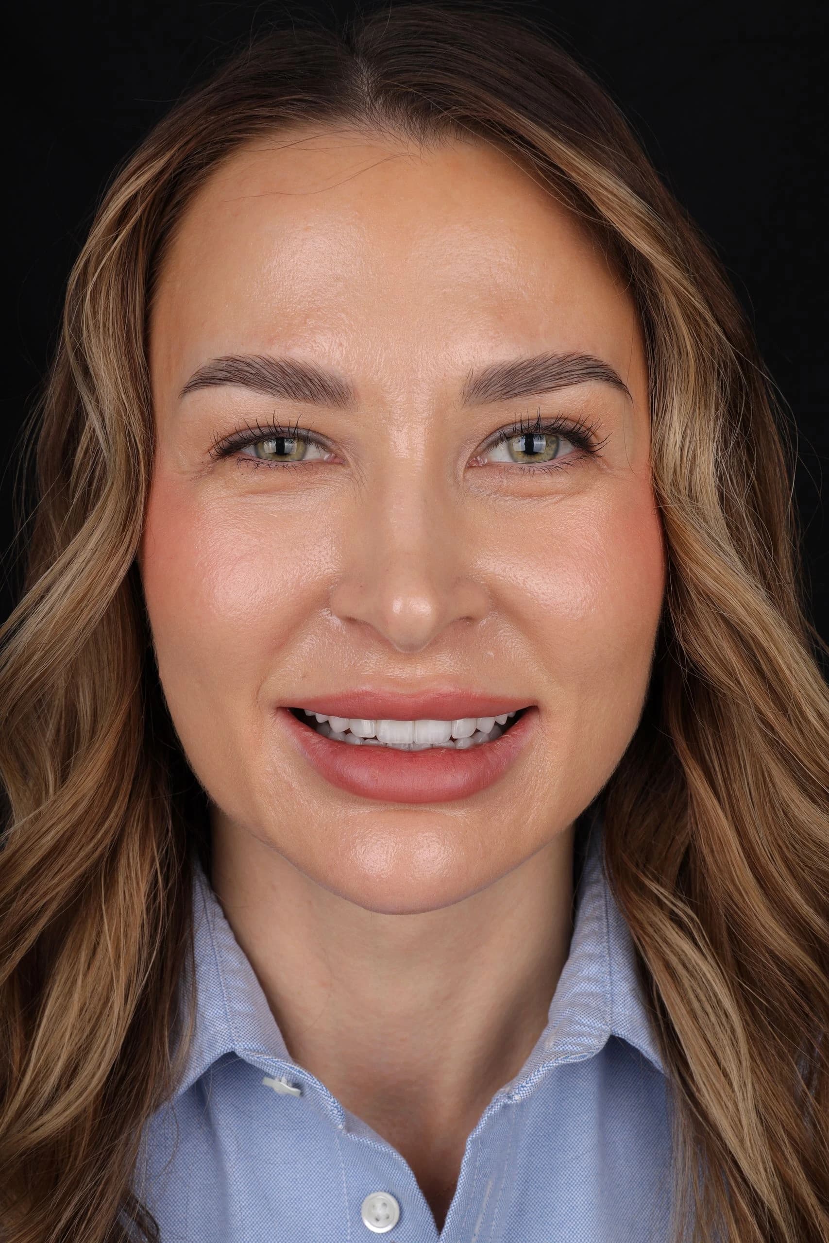 Patient smile result 15
