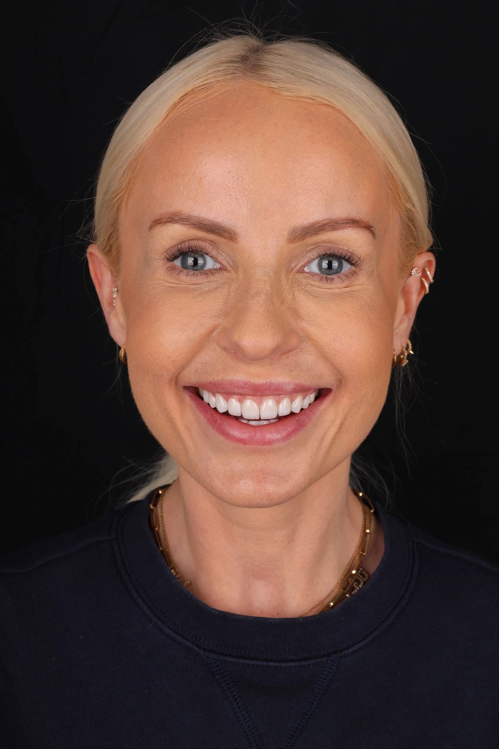Patient smile result 14