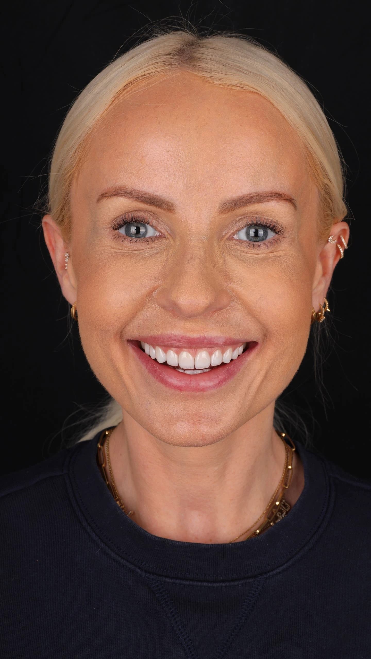 Patient smile result 32
