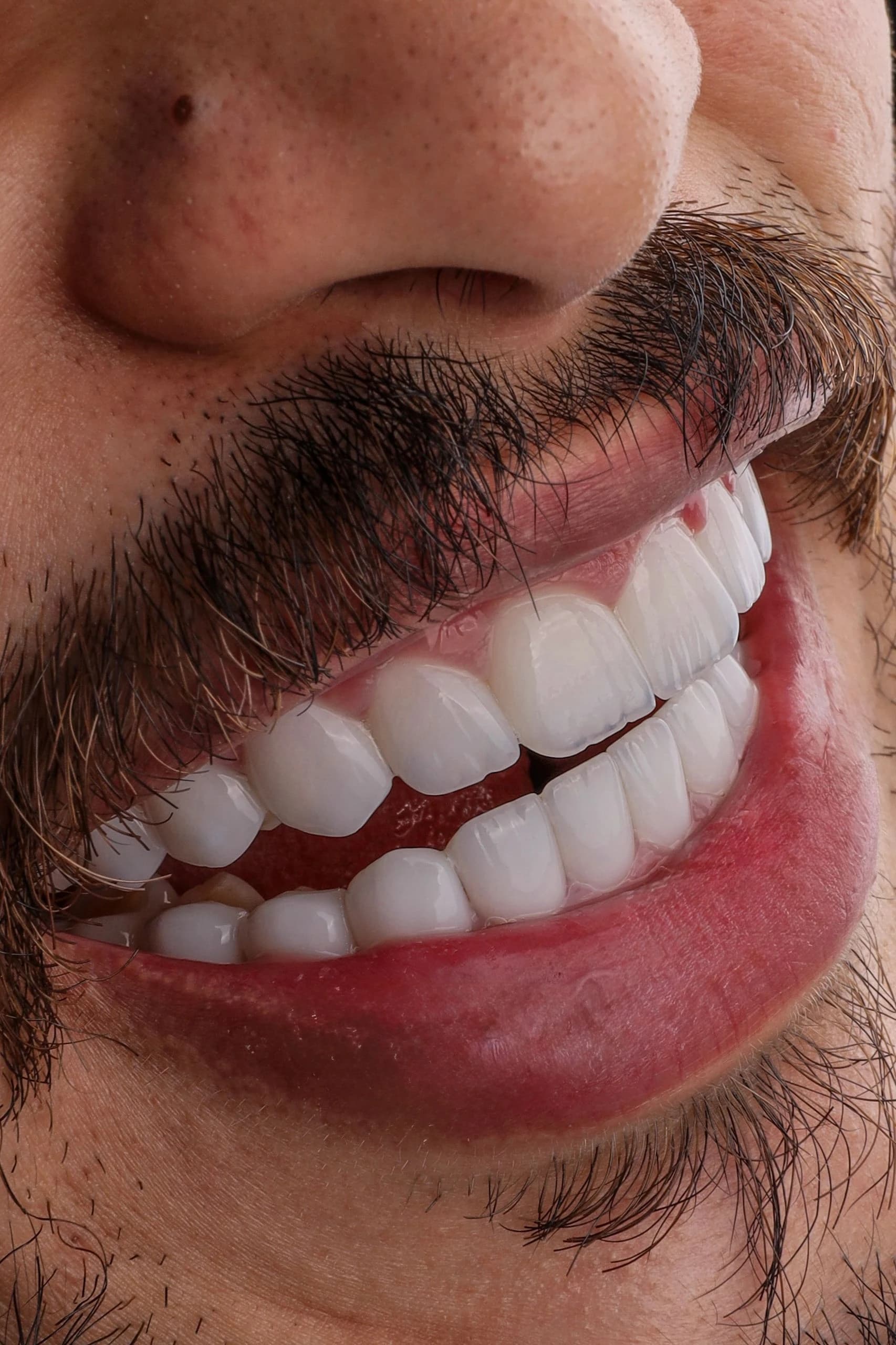 Dentist explaining whether veneer treatment is painful to a patient in Dubai