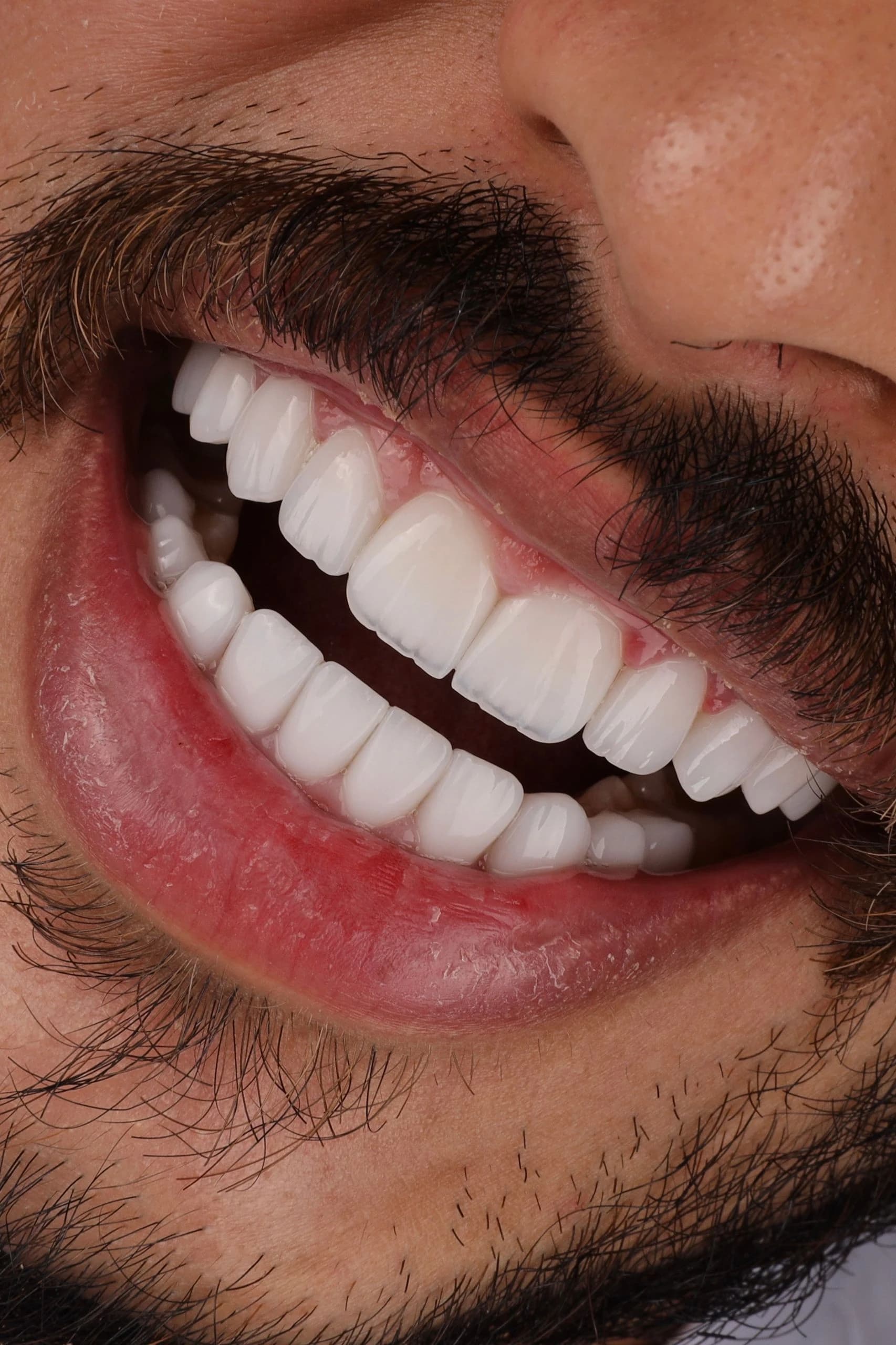 Dentist assessing a patient for no-prep veneers without tooth shaving in Dubai