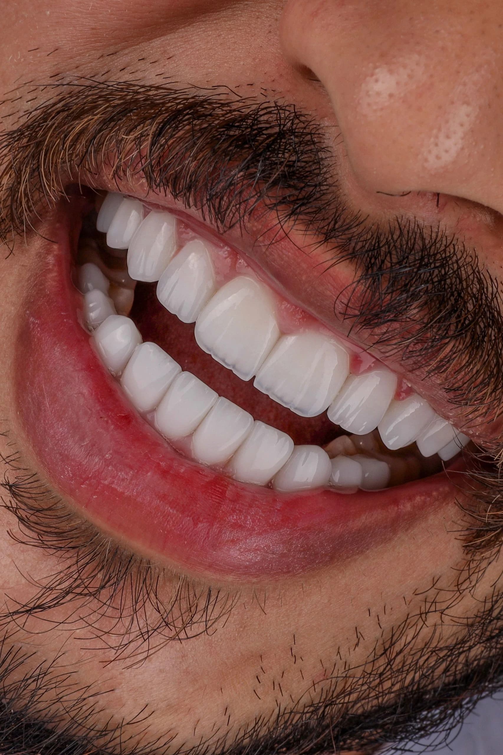 Porcelain veneer and composite bonding comparison at a Dubai dental clinic