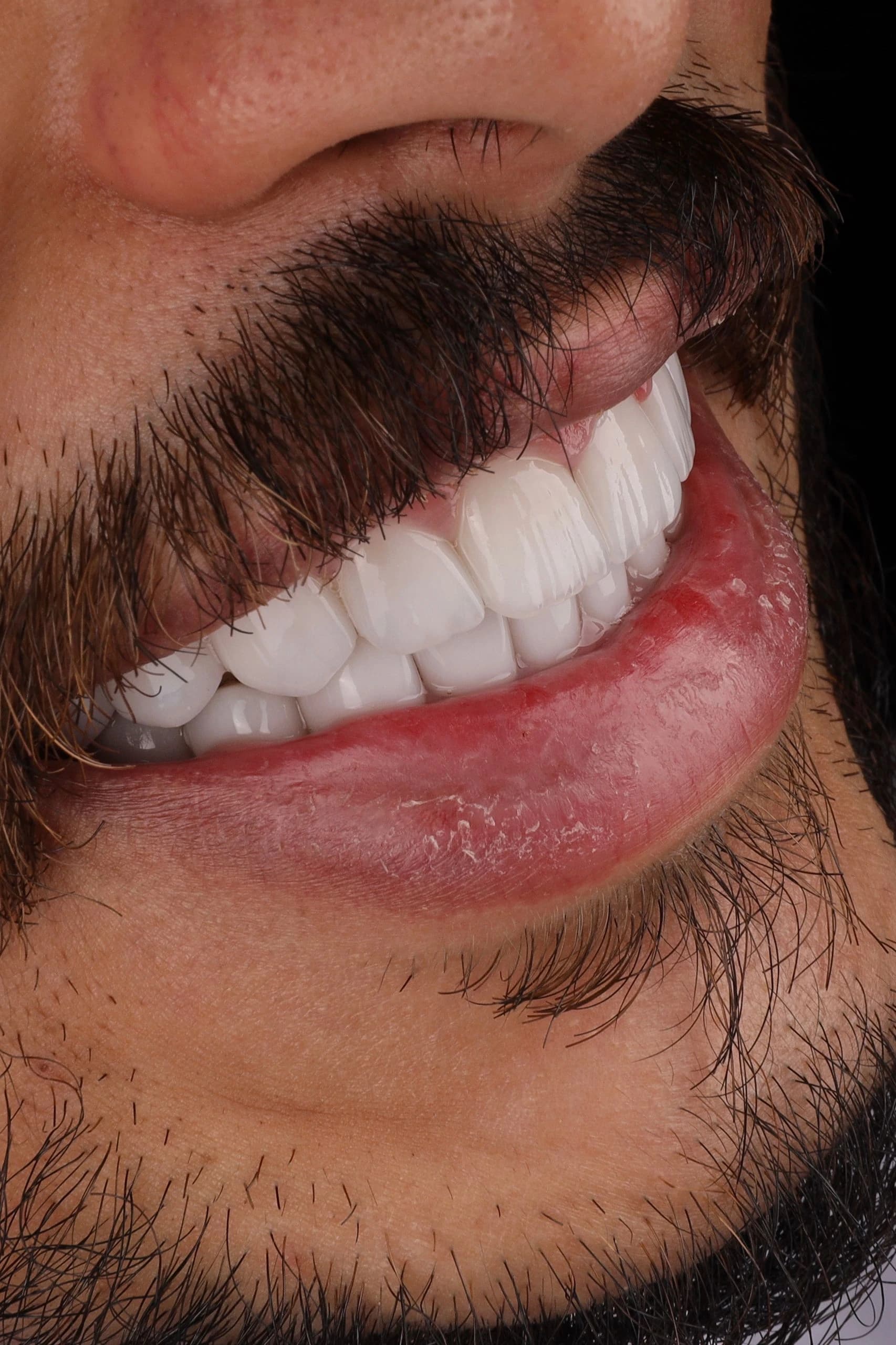 Comparison of a porcelain veneer and dental crown in Dubai
