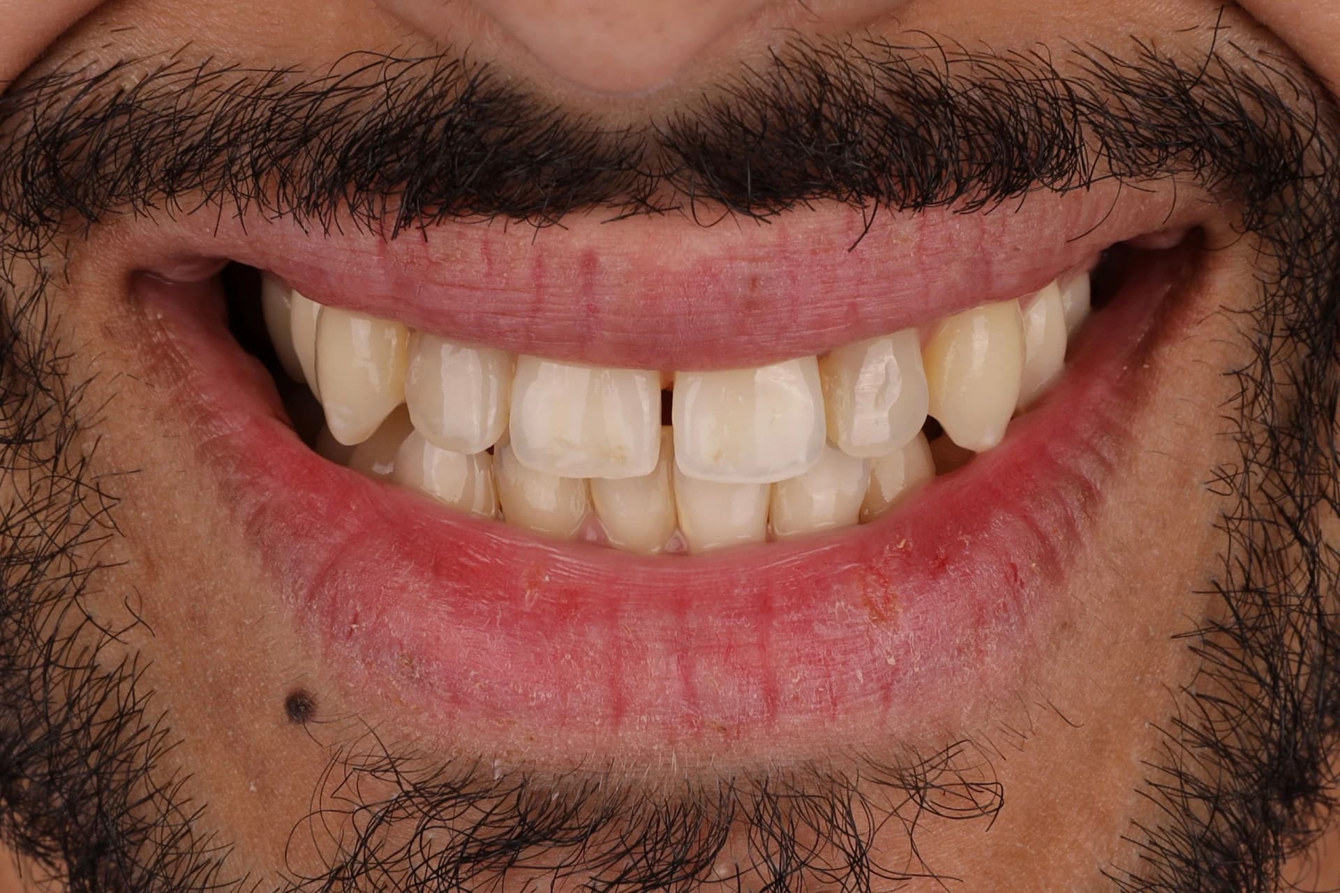 Veneers