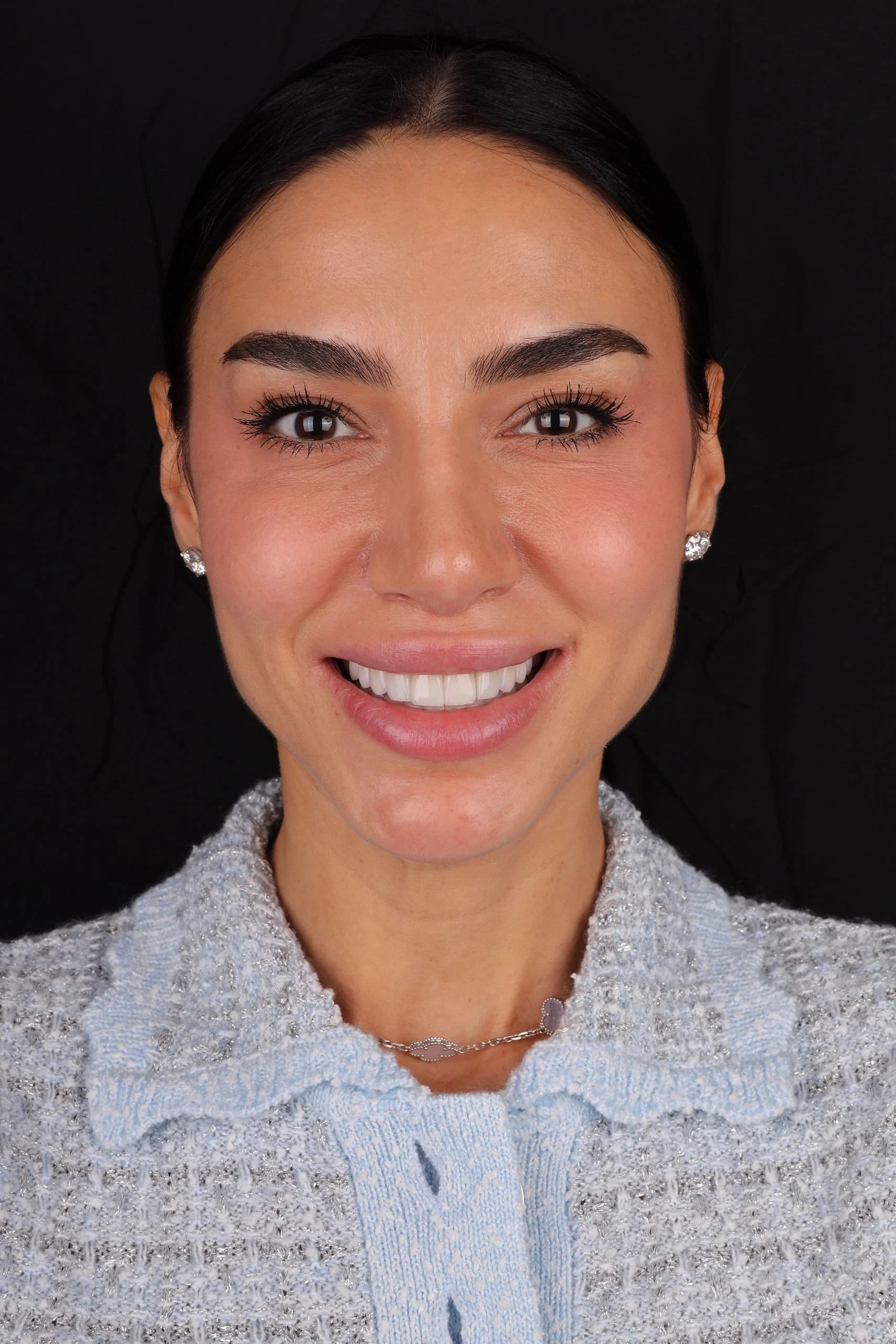 Patient smile result 6