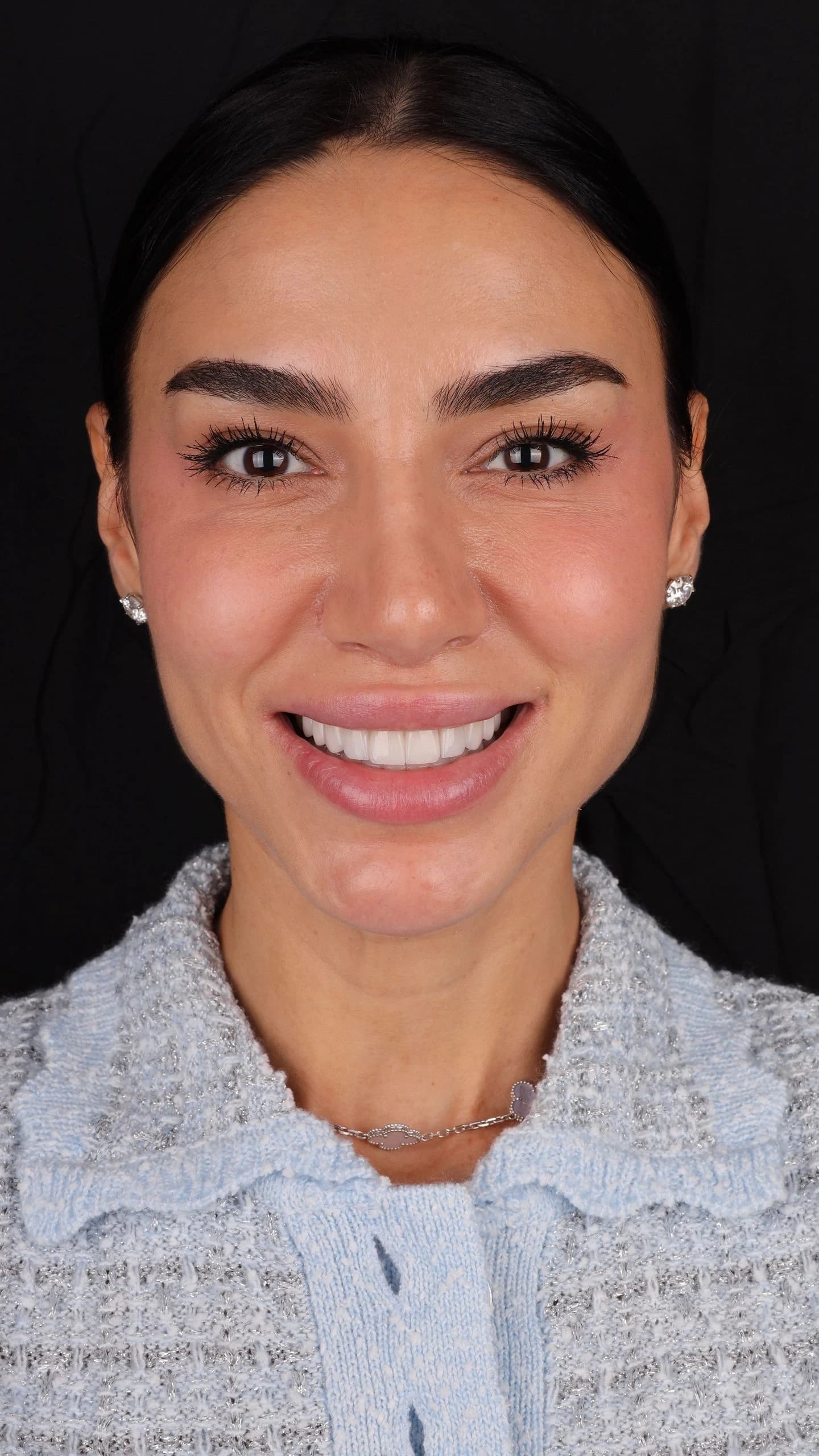 Patient smile result 26