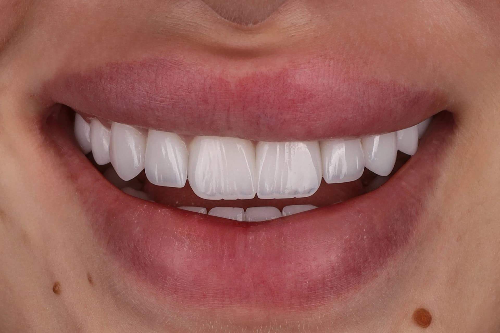 Teeth Whitening