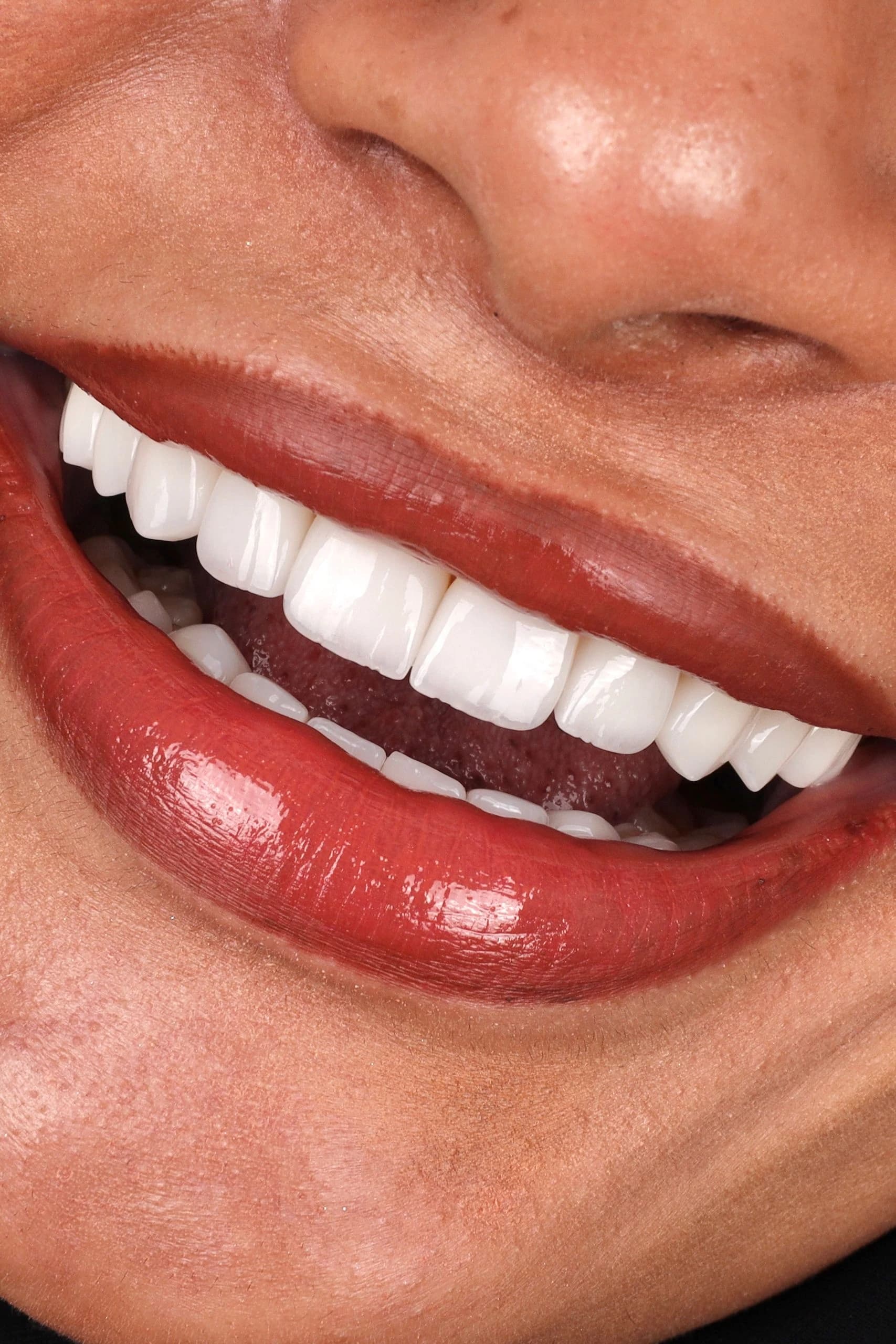 Dentist checking porcelain veneers for staining and marginal discolouration in Dubai