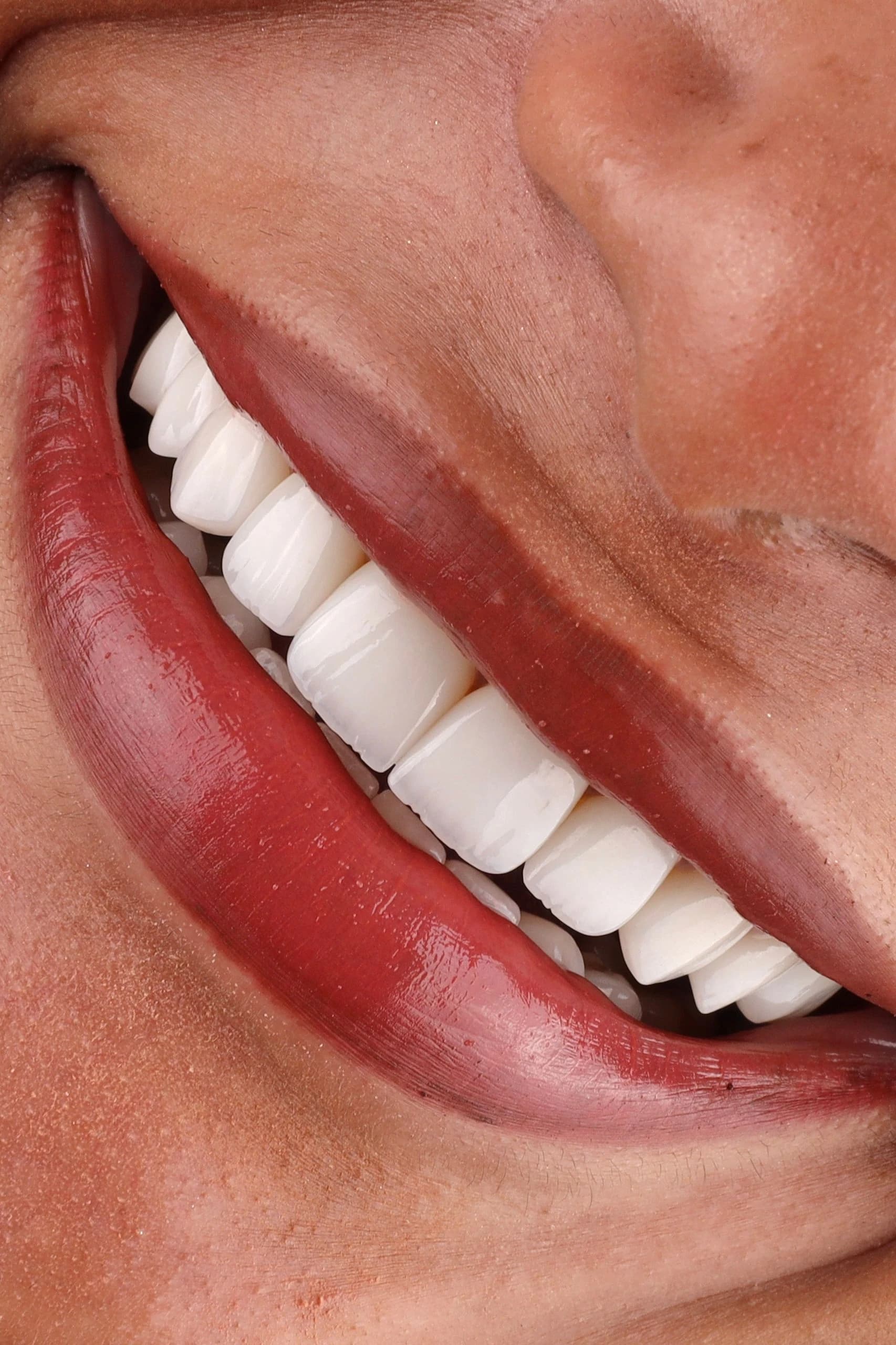 Dentist assessing slightly crooked front teeth for veneers in Dubai