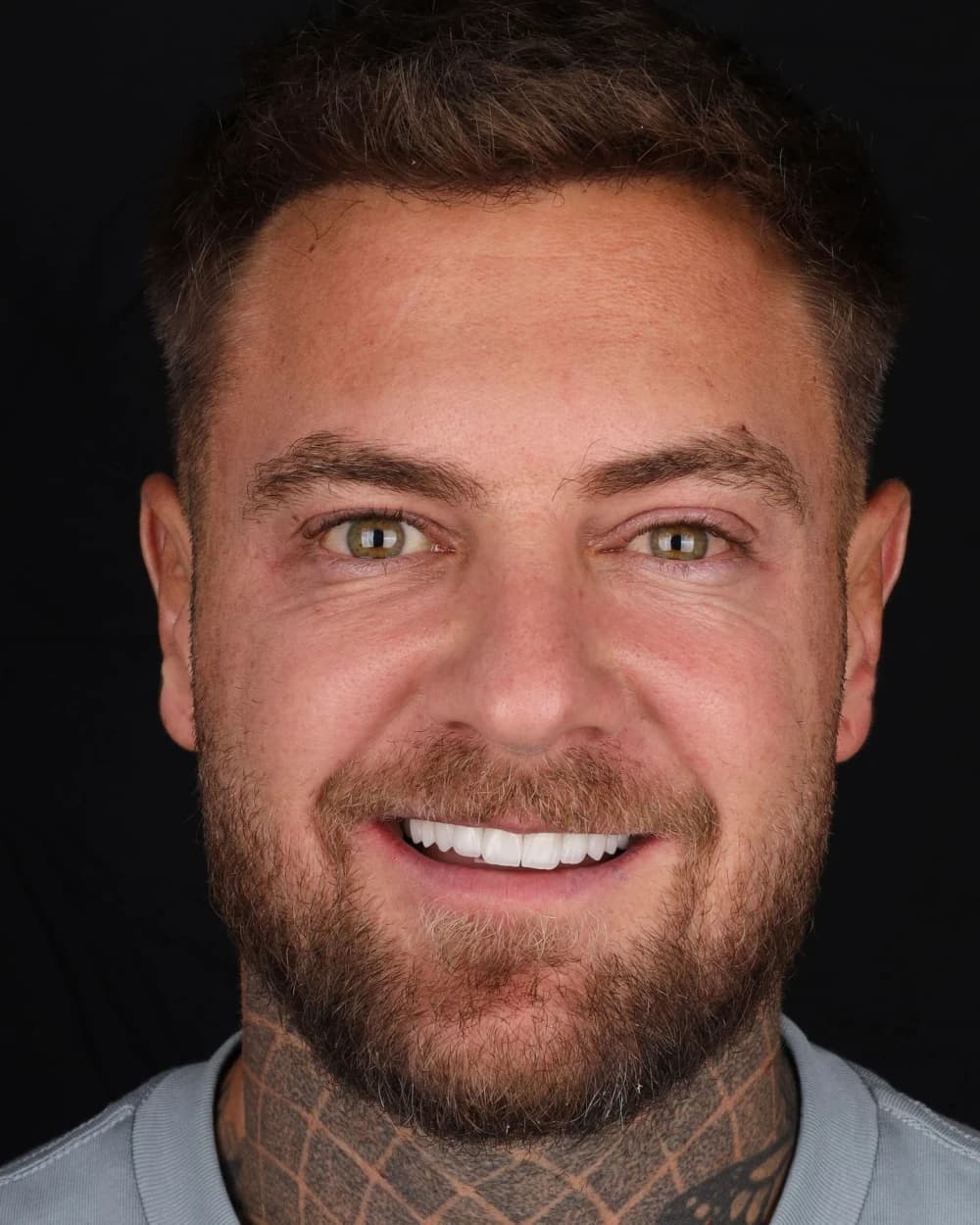 Patient smile result 15