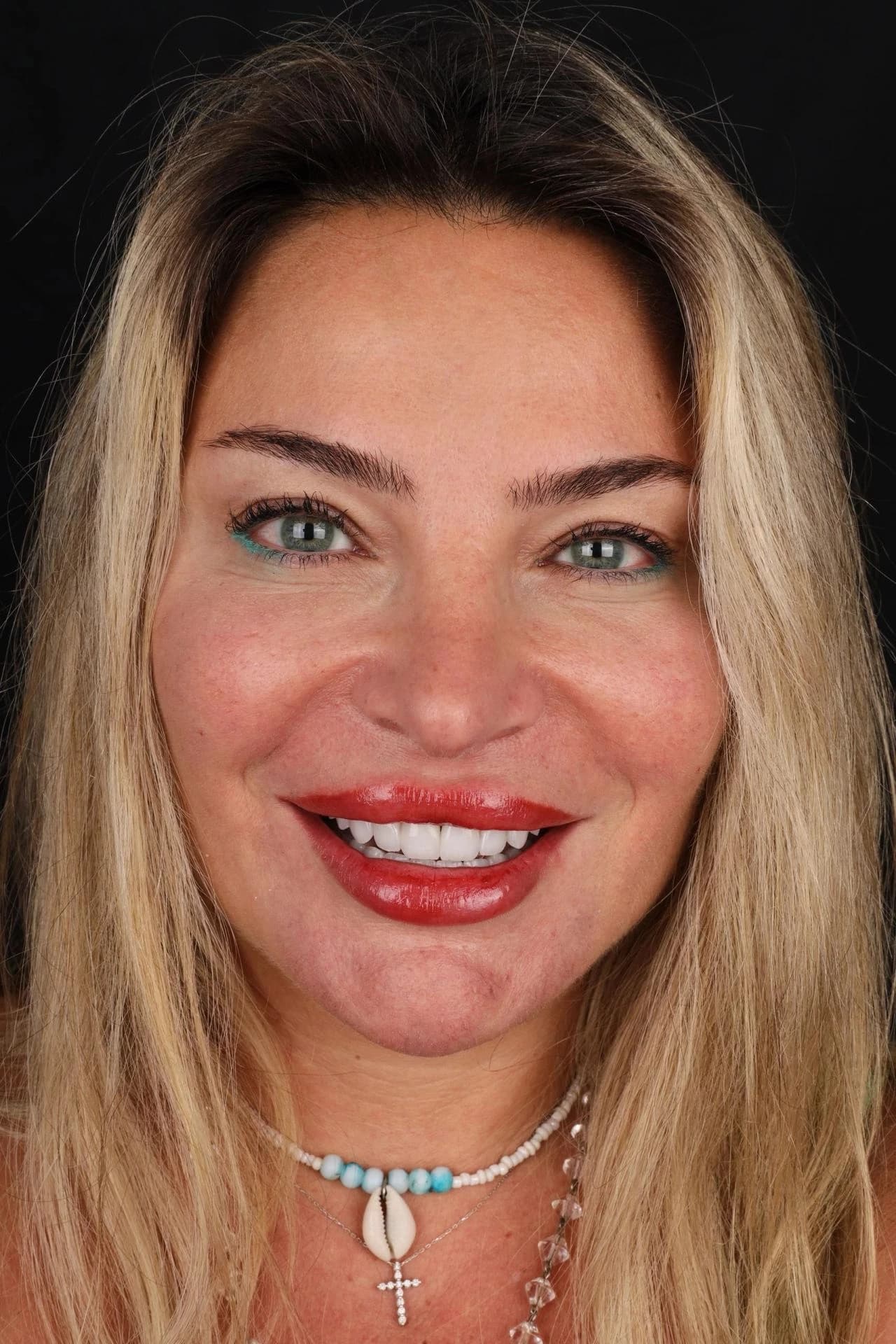 Patient smile result 32