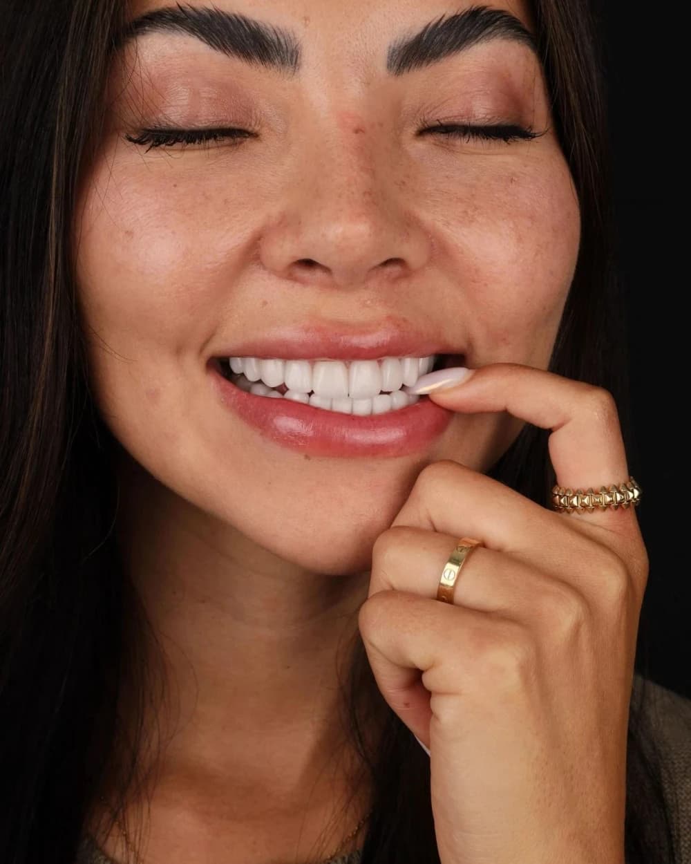 Patient smile result 3