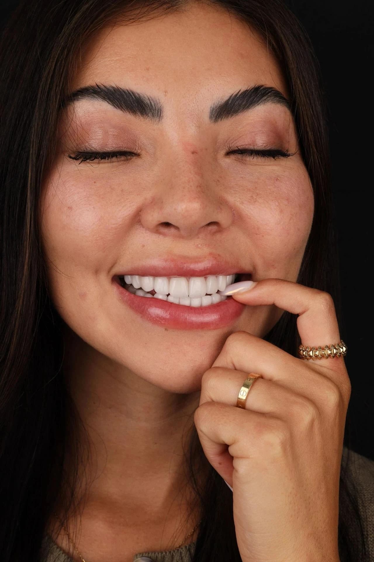 Patient smile result 26